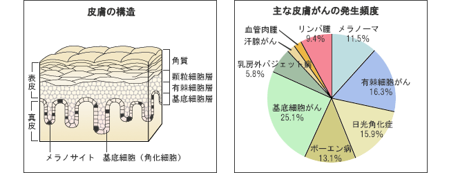 皮膚がんについて 治療方法 再発 転移 がん治療ならnpo法人日本統合医療推奨協会